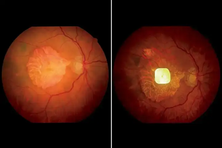 Глаз участника без ретинального имплантата (слева) и с имплантатом (справа).