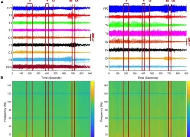 Нейробиологи зафиксировали 900 секунд мозговой активности в момент смерти.