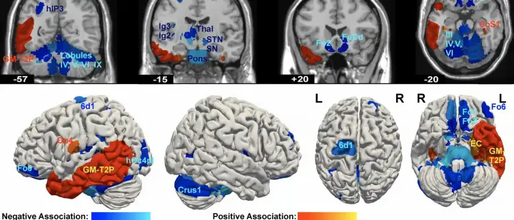 Цветные регионы показывают, где объем мозга связан с девиантным образом жизни.