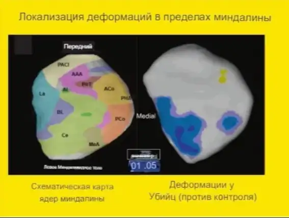Изменения в структуре мозга под названием миндалевидное тело могут указывать на то, является ли человек хладнокровным убийцей.