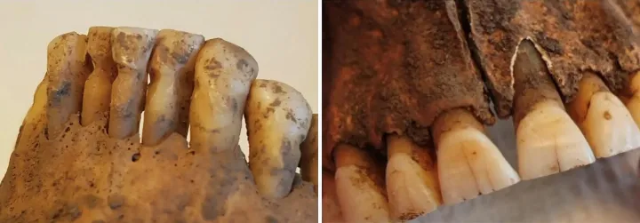 Зубы с признаками использования зубочистки (слева) и подпиливания (справа).