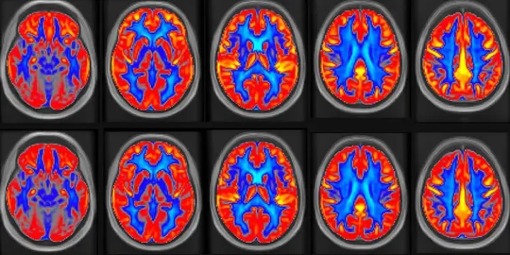 Состояние участников отслеживали при помощи МРТ.