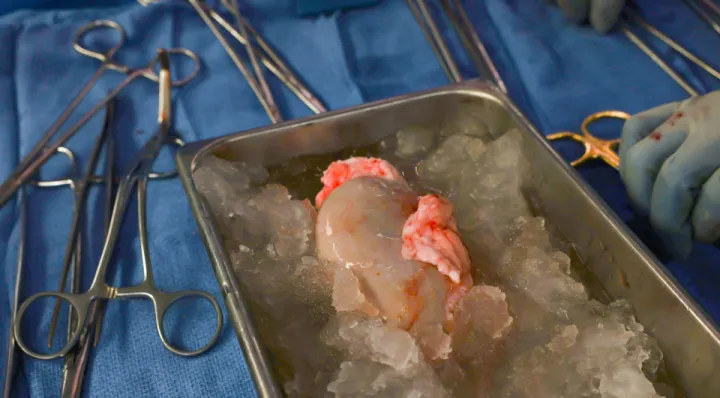 Генетически изменённая свиная почка.