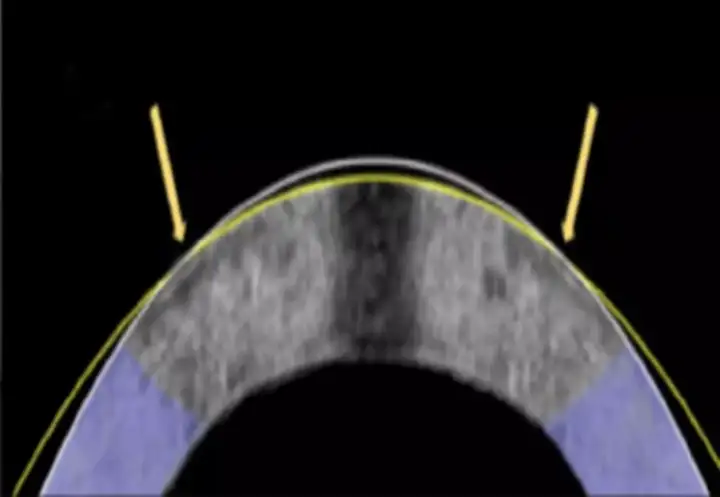 Метод электромеханического изменения формы успешно выровнял роговицу кролика.