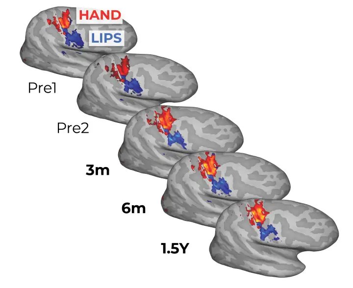 До и после ампутации в картах мозга наблюдалось очень мало изменений.