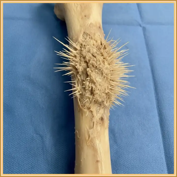 Остеосаркома.