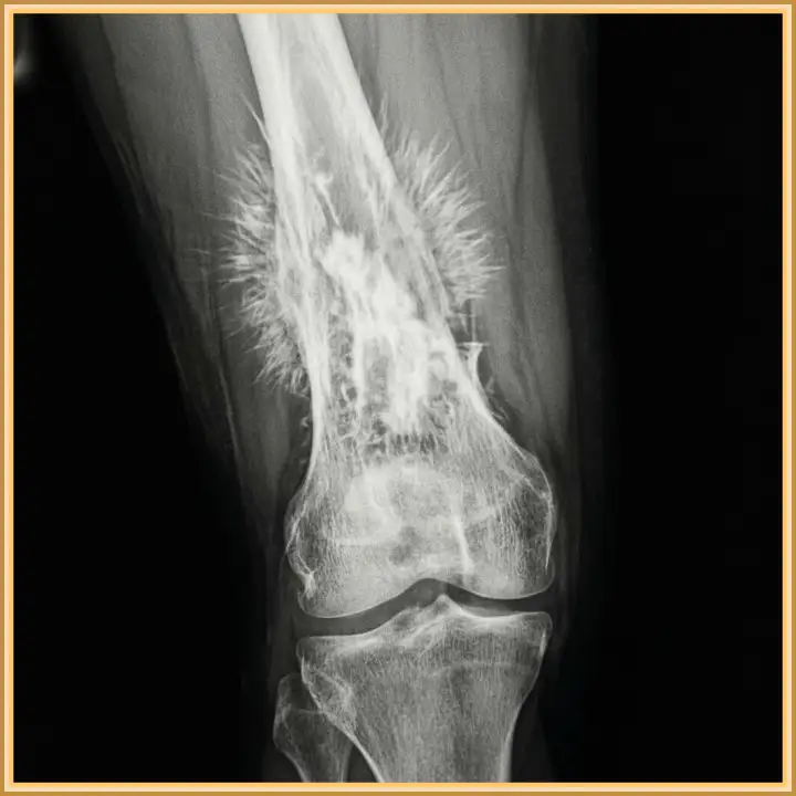 Остеосаркома на рентгене.