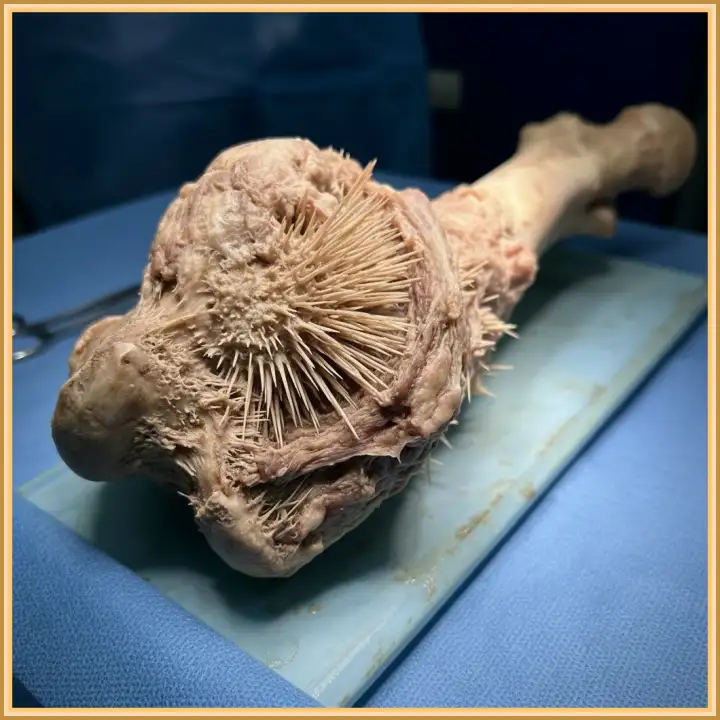 Остеосаркома - один из самых агрессивных форм рака.