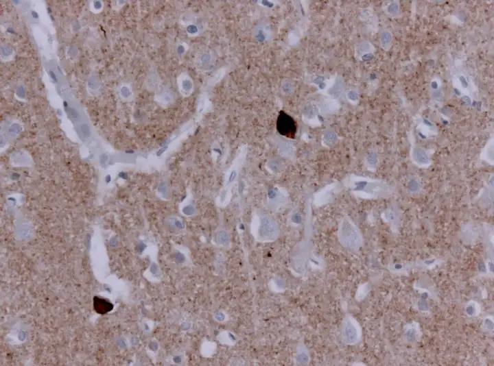 Изображение α-синуклеина у пациента с деменцией с тельцами Леви.