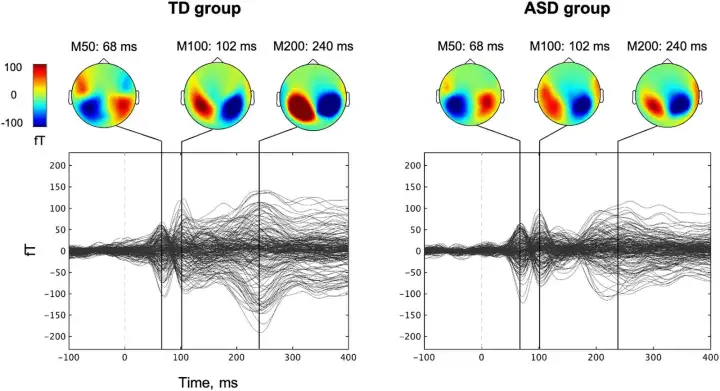 У детей с аутизмом (справа) звуковой сигнал воспринимался выраженно слабее.