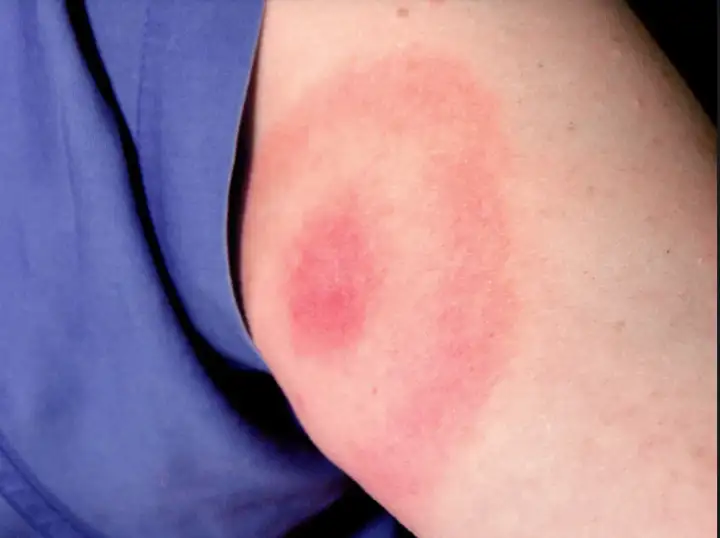 Так выглядит укус клеща.