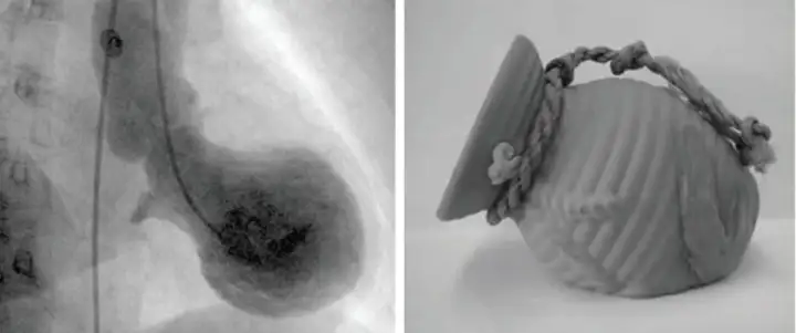 Так выглядит стрессовая кардиомиопатия, которая со стороны напоминает горшок для ловли осьминогов под названием такоцубо. Отсюда и появилось название этого смертельного состояния.